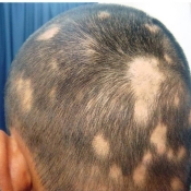 Alopecia Areata