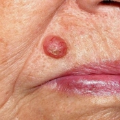 Carcinoma Basocelular (CBC)