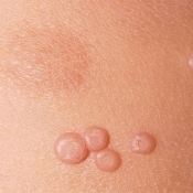 Molusco Contagioso