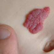 Hemangioma