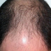 Alopecia Androgenética