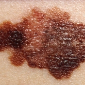 Melanoma