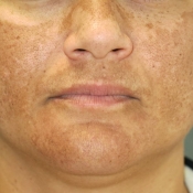 Melasma