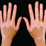 Vitiligo